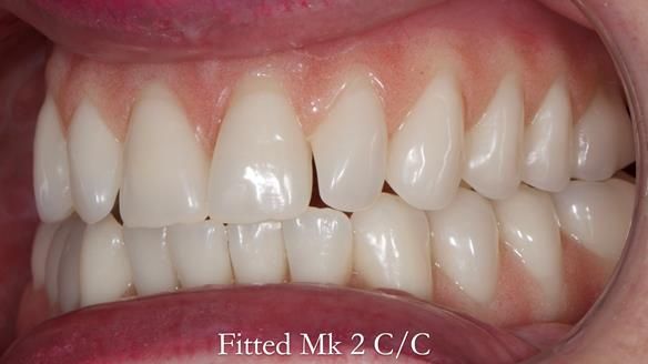 Replacing Madeline’s Complete denture FULL PROTOCOL