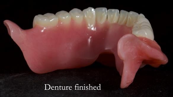 Newsletter 68 Restoring Jan’s Smile: Complete Dentures Inspired by Her Daughter’s Teeth - Post Mouth Surgery