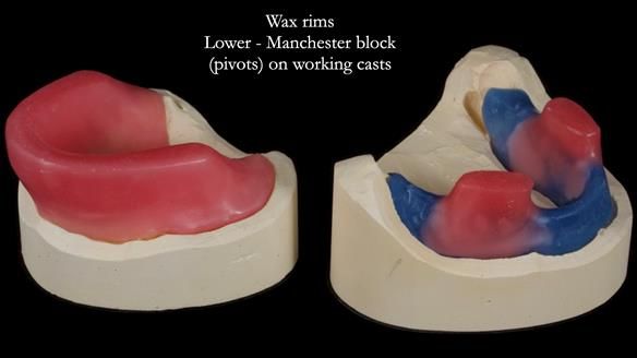 Newsletter 74: Ken’s Case Study Complete Dentures - Life Like and Age Appropriate