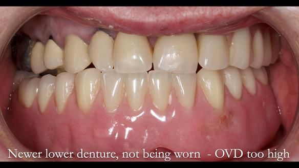 Newsletter 44 - extreme removable prosthodontics – engineering a super-strong and ultra-thin over denture