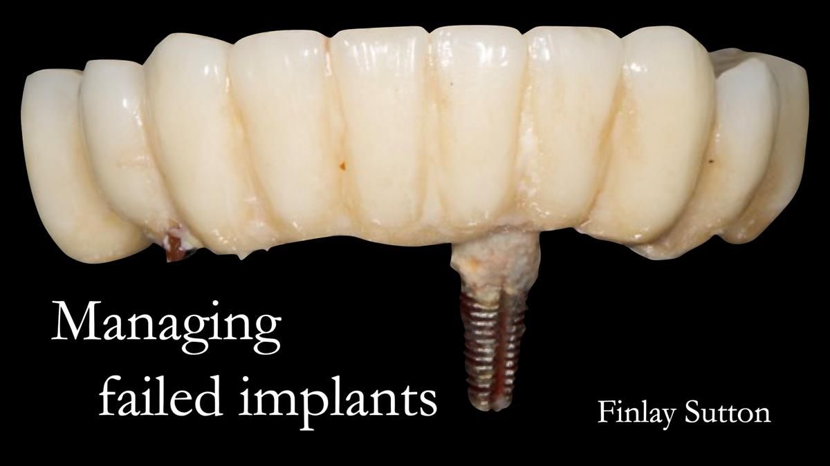 Newsletter 49 Managing Estelle’s failing implants with dentures FULL PROTOCOL