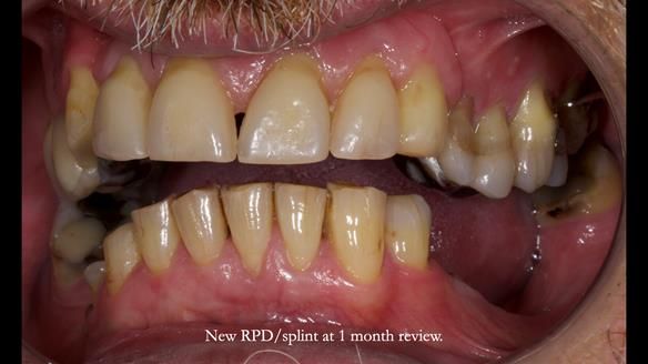 How Keith’s combat denture transformed his life – Newsletter 73