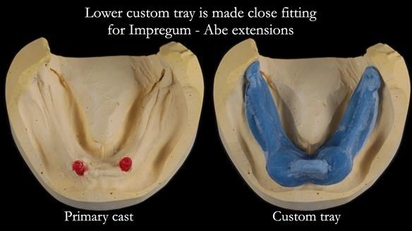 Newsletter 65 Marisa Provision of Complete Dentures on badly placed implants