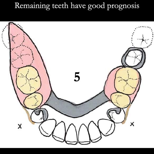 Universal Scandinavian partial denture designs