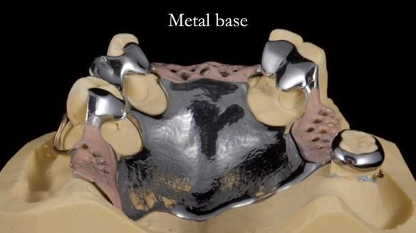 Managing Edgar “THE SCEPTIC” with an RPD/Splint FULL CASE