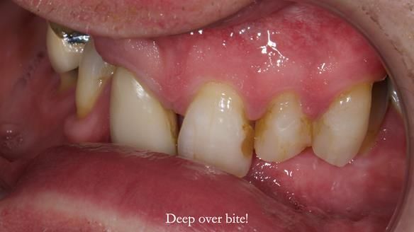 Read Newsletter 67 - Brian's COMBAT DENTURE Case Study