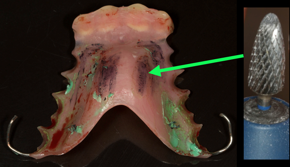 Figure 33 The denture didn't seat properly on the palate. This was because of the primary impression shown in figure 16 didn't fully record the palate.