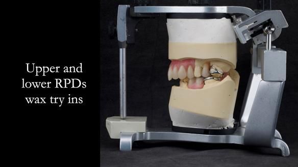 Eileen's transformation with upper and lower RPDs of Scandinavian hygienic design FULL PROTOCOL