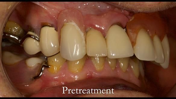 Eileen's transformation with upper and lower RPDs of Scandinavian hygienic design FULL PROTOCOL