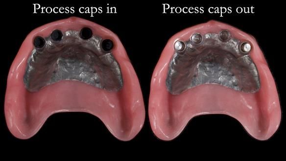 Newsletter 65 Marisa Provision of Complete Dentures on badly placed implants