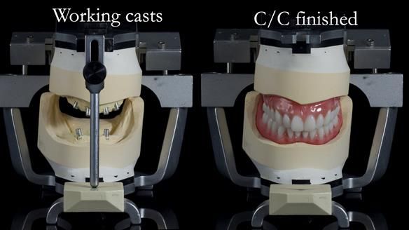 Newsletter 65 Marisa Provision of Complete Dentures on badly placed implants