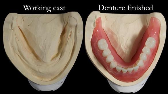 Newsletter 68 Restoring Jan’s Smile: Complete Dentures Inspired by Her Daughter’s Teeth - Post Mouth Surgery