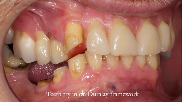 How Keith’s combat denture transformed his life – Newsletter 73