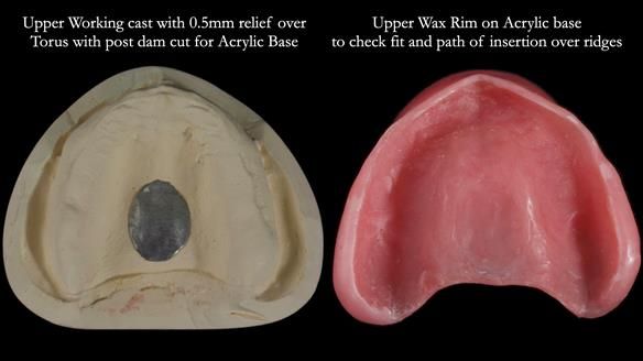 Newsletter 70 Complete Denture Treatment for Kate: A Case Study on Natural-Looking Dentures and Implant-Supported Overdentures