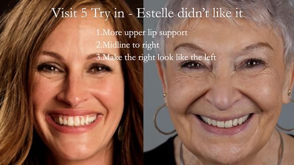 Newsletter 49 Managing Estelle’s failing implants with dentures FULL PROTOCOL