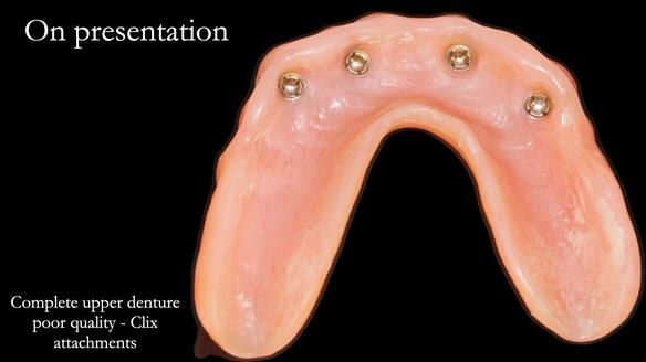 Newsletter 65 Marisa Provision of Complete Dentures on badly placed implants