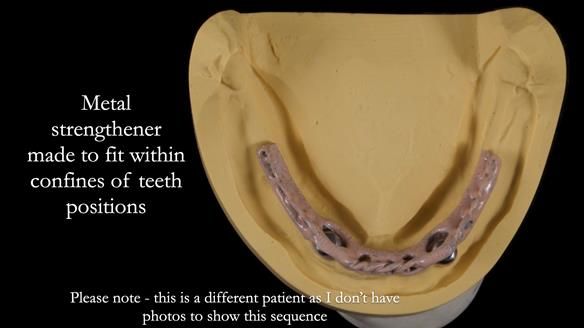 Newsletter 65 Marisa Provision of Complete Dentures on badly placed implants