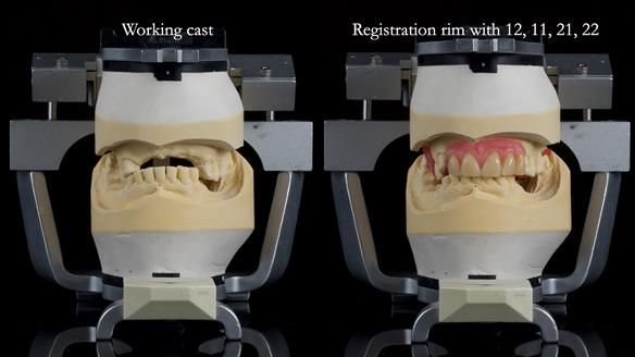 How Keith’s combat denture transformed his life – Newsletter 73