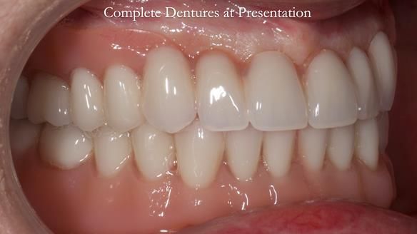 Newsletter 70 Complete Denture Treatment for Kate: A Case Study on Natural-Looking Dentures and Implant-Supported Overdentures