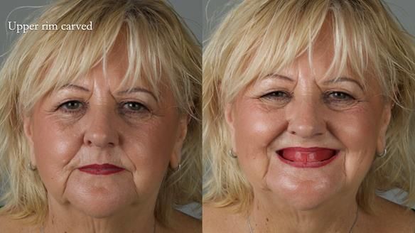 Newsletter 68 Restoring Jan’s Smile: Complete Dentures Inspired by Her Daughter’s Teeth - Post Mouth Surgery