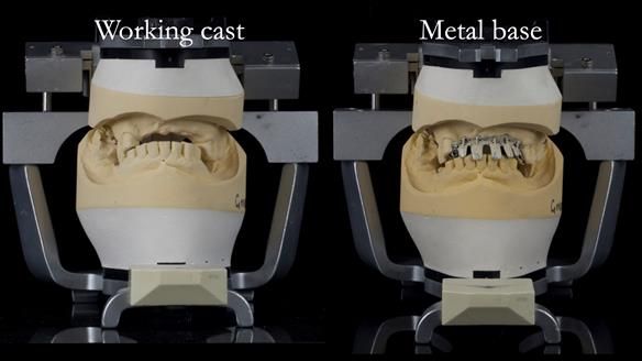 How Keith’s combat denture transformed his life – Newsletter 73