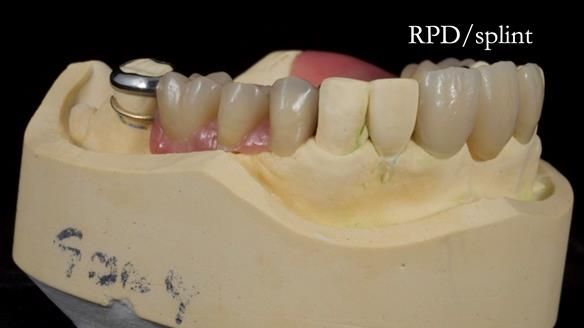 Managing Edgar “THE SCEPTIC” with an RPD/Splint FULL CASE