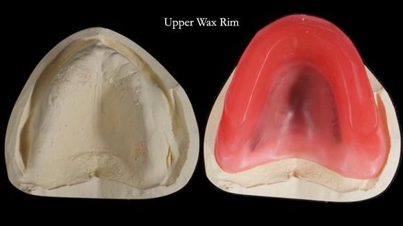 Newsletter 68 Restoring Jan’s Smile: Complete Dentures Inspired by Her Daughter’s Teeth - Post Mouth Surgery