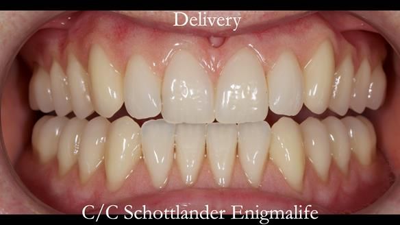 Newsletter 48 Mavis's Complete denture FULL PROTOCOL