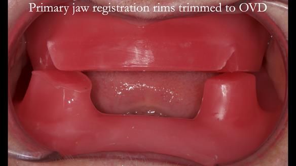 Newsletter 68 Restoring Jan’s Smile: Complete Dentures Inspired by Her Daughter’s Teeth - Post Mouth Surgery