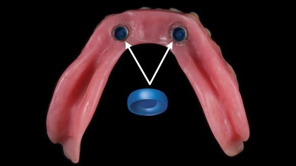 Newsletter 70 Complete Denture Treatment for Kate: A Case Study on Natural-Looking Dentures and Implant-Supported Overdentures