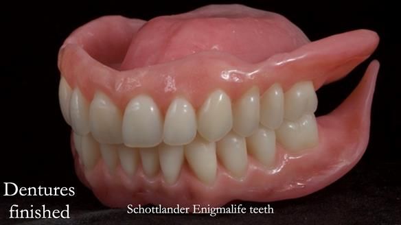 Newsletter 70 Complete Denture Treatment for Kate: A Case Study on Natural-Looking Dentures and Implant-Supported Overdentures