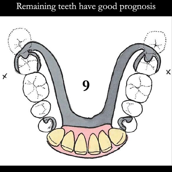 Universal Scandinavian partial denture designs