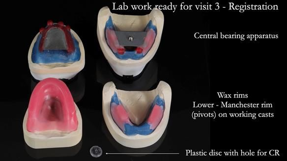 Newsletter 65 Marisa Provision of Complete Dentures on badly placed implants