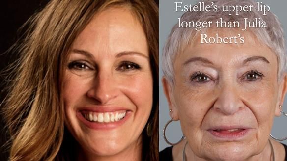 Newsletter 49 Managing Estelle’s failing implants with dentures FULL PROTOCOL