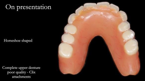 Newsletter 65 Marisa Provision of Complete Dentures on badly placed implants