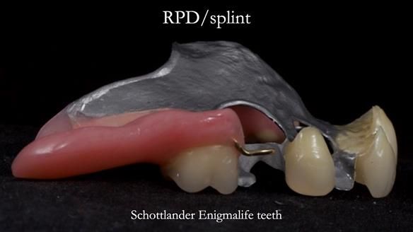 Managing Edgar “THE SCEPTIC” with an RPD/Splint FULL CASE