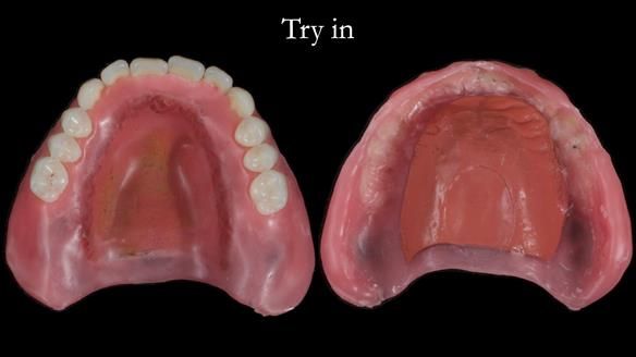 Newsletter 70 Complete Denture Treatment for Kate: A Case Study on Natural-Looking Dentures and Implant-Supported Overdentures