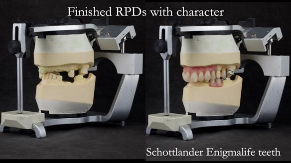 Eileen's transformation with upper and lower RPDs of Scandinavian hygienic design FULL PROTOCOL