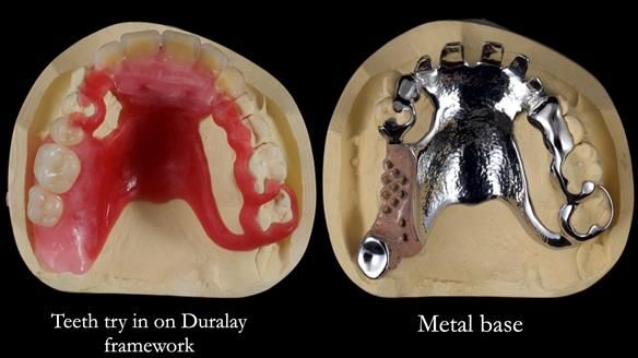 How Keith’s combat denture transformed his life – Newsletter 73