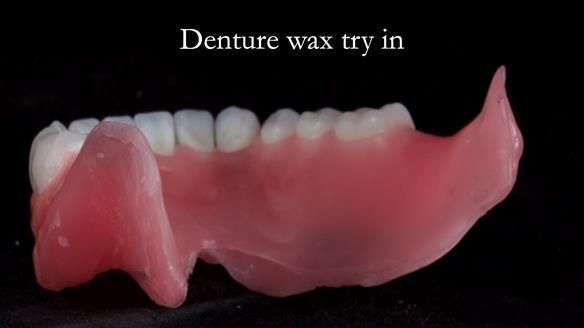 Newsletter 65 Marisa Provision of Complete Dentures on badly placed implants