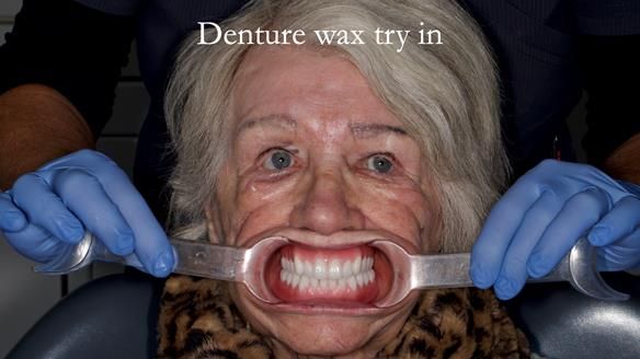 Newsletter 65 Marisa Provision of Complete Dentures on badly placed implants