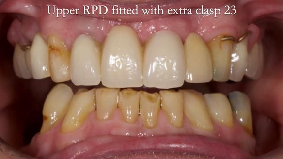 Managing Edgar “THE SCEPTIC” with an RPD/Splint FULL CASE