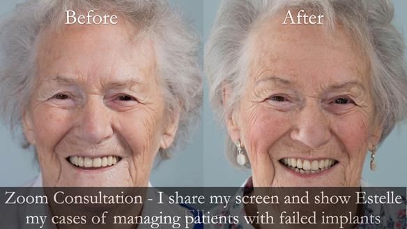 Newsletter 49 Managing Estelle’s failing implants with dentures FULL PROTOCOL