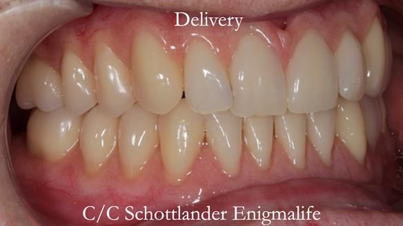 Newsletter 48 Mavis's Complete denture FULL PROTOCOL