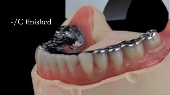 Newsletter 44 - extreme removable prosthodontics – engineering a super-strong and ultra-thin over denture