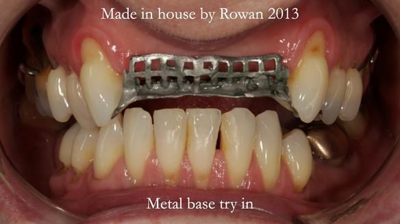 Newsletter 66 Long term case study. Life changing metal based RPD made for Anna