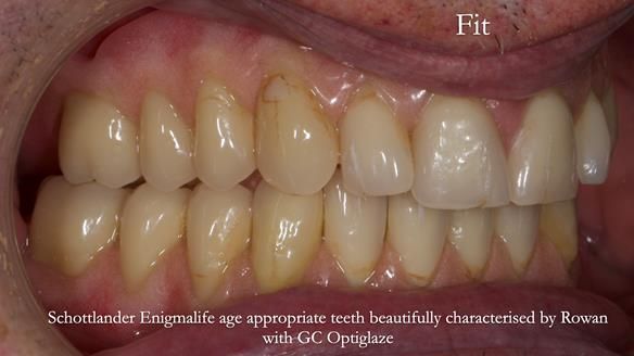 Newsletter 74: Ken’s Case Study Complete Dentures - Life Like and Age Appropriate