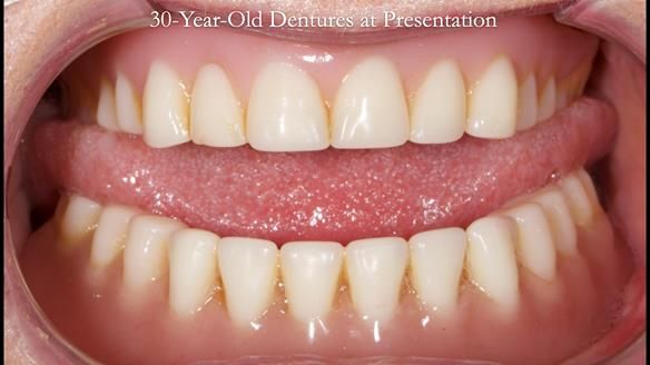 Newsletter 68 Restoring Jan’s Smile: Complete Dentures Inspired by Her Daughter’s Teeth - Post Mouth Surgery