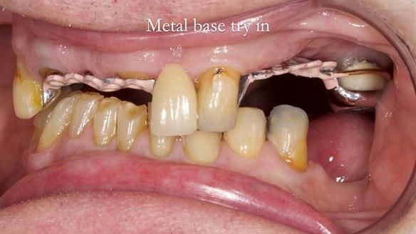 Managing Edgar “THE SCEPTIC” with an RPD/Splint FULL CASE