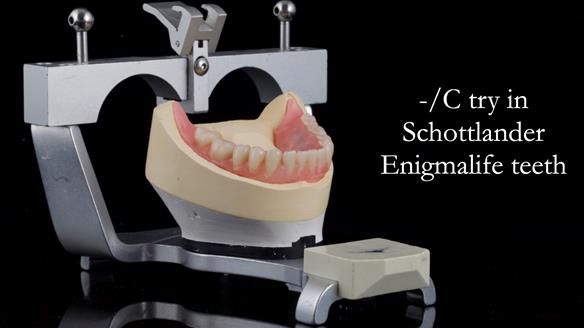 Newsletter 44 - extreme removable prosthodontics – engineering a super-strong and ultra-thin over denture